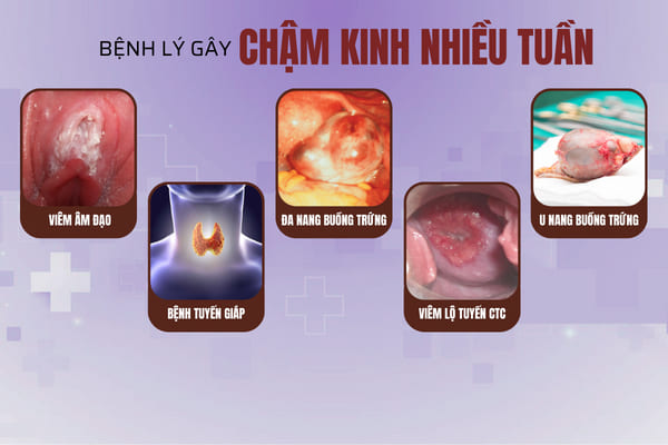cac-benh-ly-gay-ra-cham-kinh-nhieu-tuan
