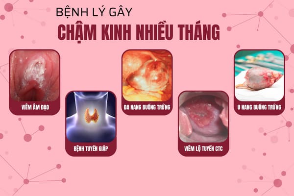 cham-kinh-nhieu-thang-la-trieu-chung-canh-bao-nhieu-benh-ly-nguy-hiem