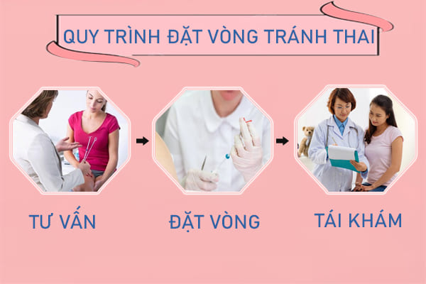 Đặt vòng tránh thai cần lưu ý những gì?
