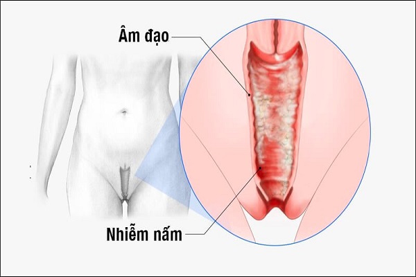 Những nguy hiểm khi bị nhiễm nấm candida và cách chữa trị hiệu quả
