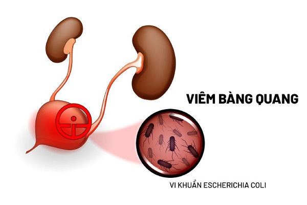 Cách chữa viêm bàng quang ở nữ tại phòng khám Quy Nhơn