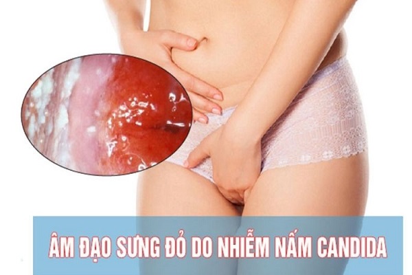 nam-candida-vung-kin-5