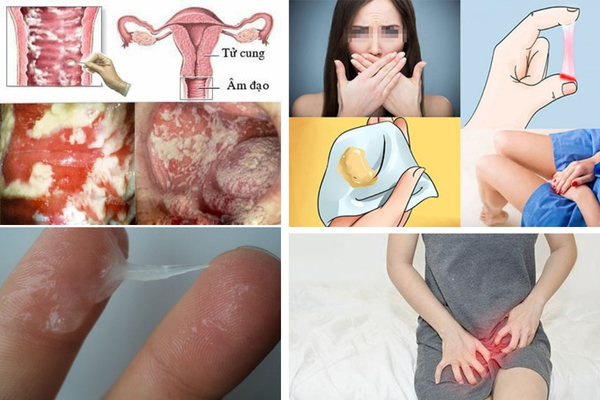 Nhiễm trùng âm đạo điều trị ngay khi có triệu chứng ban đầu