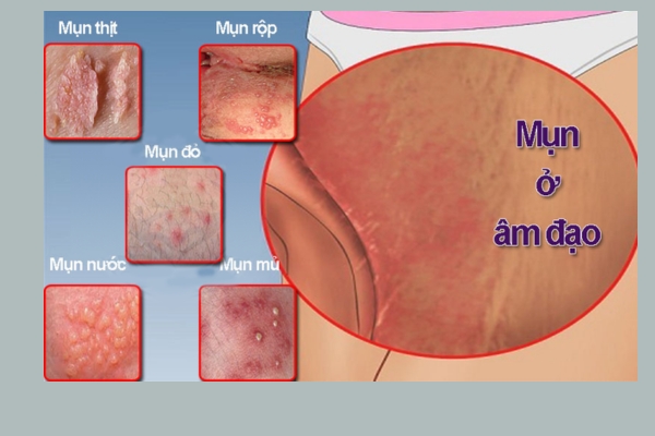 Nổi Mụn Âm Đạo Thì Phải Làm Sao? Nguyên Nhân Và Cách Khắc Phục