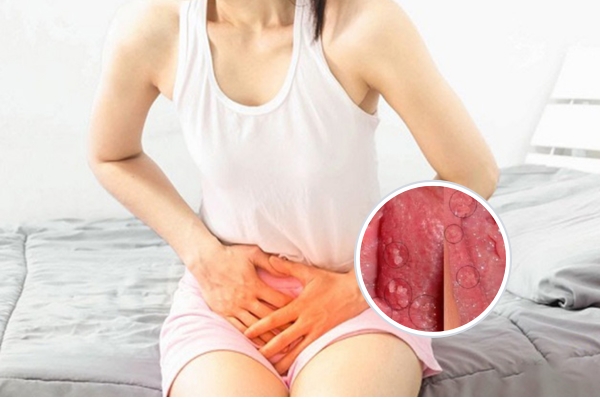Thịt thừa thịt dư ở vùng kín nguyên nhân và cách điều trị