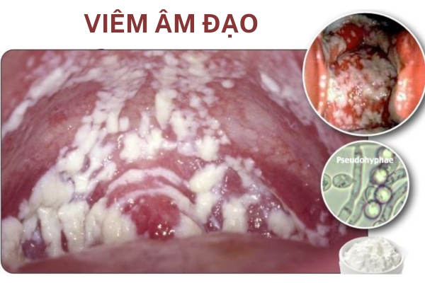 Dấu hiệu viêm âm đạo cấp và mãn tính