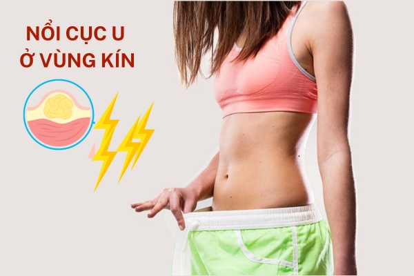 Nổi cục u ở vùng kín nữ giới là bị bệnh gì?