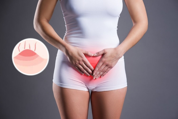 Nổi mụn mủ ở âm đạo điều trị cách nào nhanh hết?