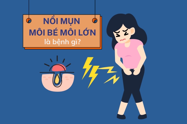 Nổi mụn môi bé môi lớn là bệnh gì?