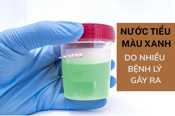 Nước tiểu màu xanh là dấu hiệu bệnh gì? Sự thật khiến nhiều người “đứng hình”