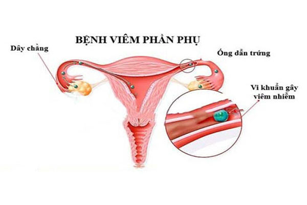Bị viêm phần phụ ở nữ giới hé lộ nhiều nguy hiểm tiềm ẩn